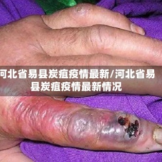 河北省易县炭疽疫情最新/河北省易县炭疽疫情最新情况