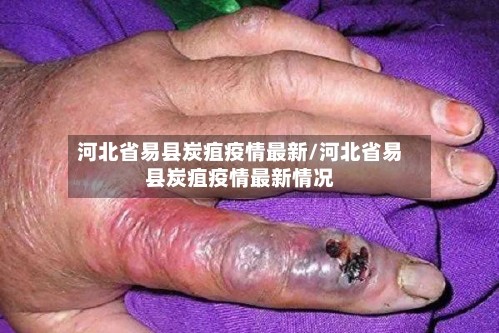 河北省易县炭疽疫情最新/河北省易县炭疽疫情最新情况