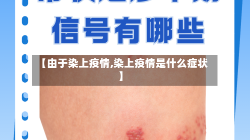 【由于染上疫情,染上疫情是什么症状】