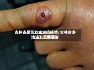 吉林省是否发生炭疽疫情/吉林省多地连发重要通告
