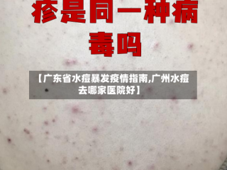 【广东省水痘暴发疫情指南,广州水痘去哪家医院好】