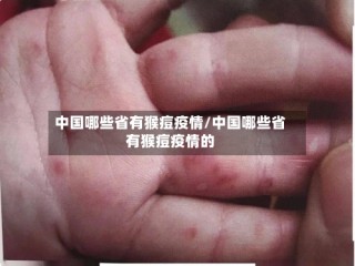 中国哪些省有猴痘疫情/中国哪些省有猴痘疫情的