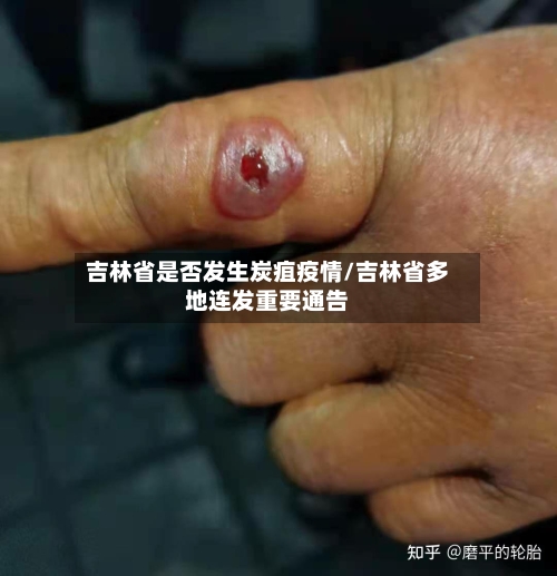 吉林省是否发生炭疽疫情/吉林省多地连发重要通告-第1张图片