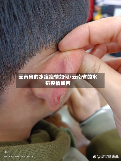 云南省的水痘疫情如何/云南省的水痘疫情如何-第2张图片