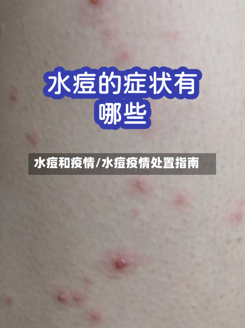 水痘和疫情/水痘疫情处置指南-第2张图片