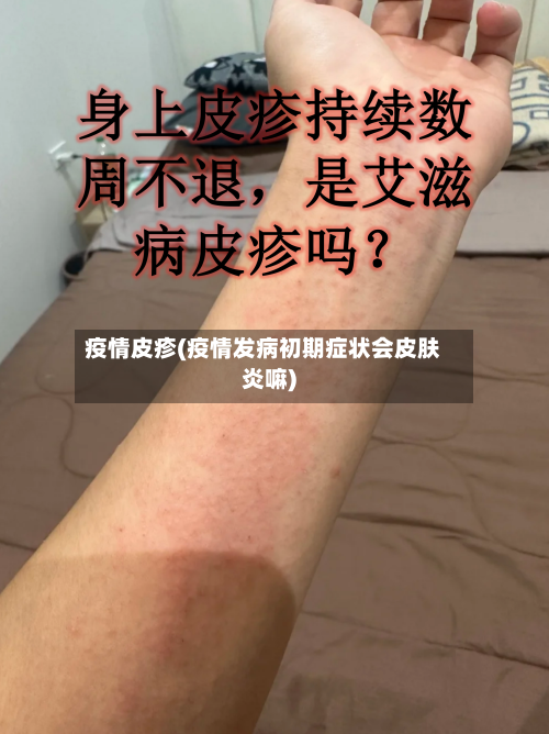 疫情皮疹(疫情发病初期症状会皮肤炎嘛)-第1张图片